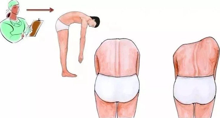 脊柱側(cè)彎早發(fā)現(xiàn)，早治療