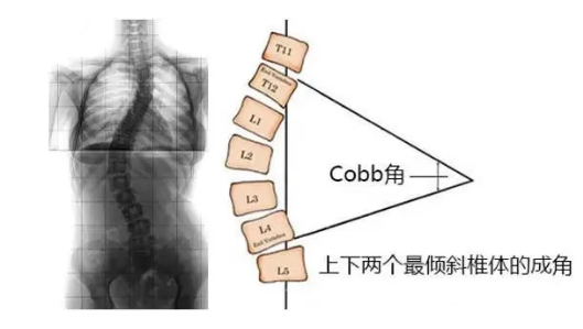 脊柱側(cè)彎角度怎么測量？