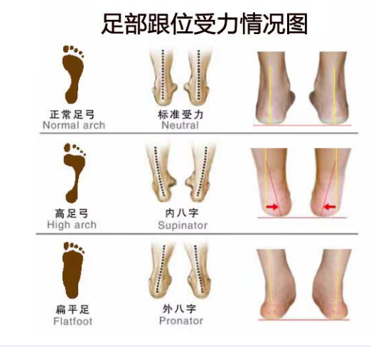 扁平足和脊柱側(cè)彎之間有關(guān)聯(lián)嗎？