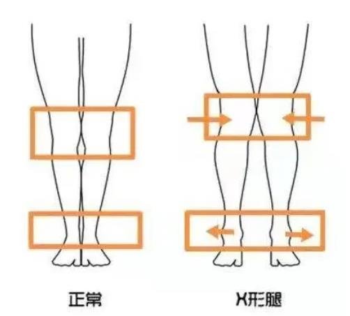 膝關(guān)節(jié)外翻